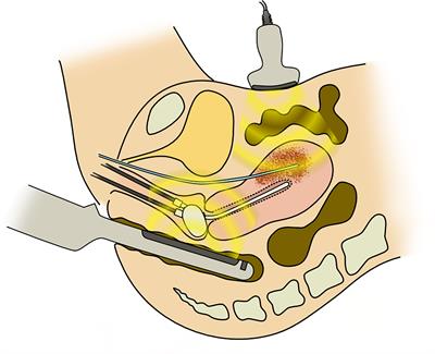 High-Dose-Rate Interstitial Brachytherapy for Deeply Situated Gynecologic Tumors Guided by Combination of Transrectal and Transabdominal Ultrasonography: A Technical Note